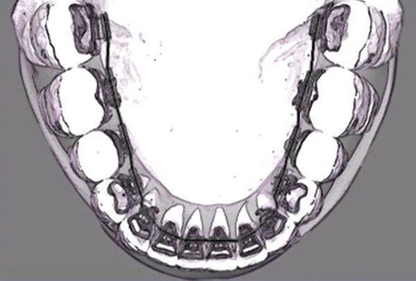 WIN linguale Zahnspange Röntgenbild Unterkiefer